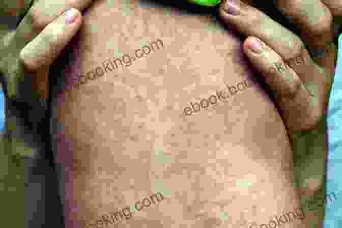 Measles Rash Virus Mania: Corona/COVID 19 Measles Swine Flu Cervical Cancer Avian Flu SARS BSE Hepatitis C AIDS Polio Spanish Flu How The Medical Industry Billion Dollar Profits At Our Expense